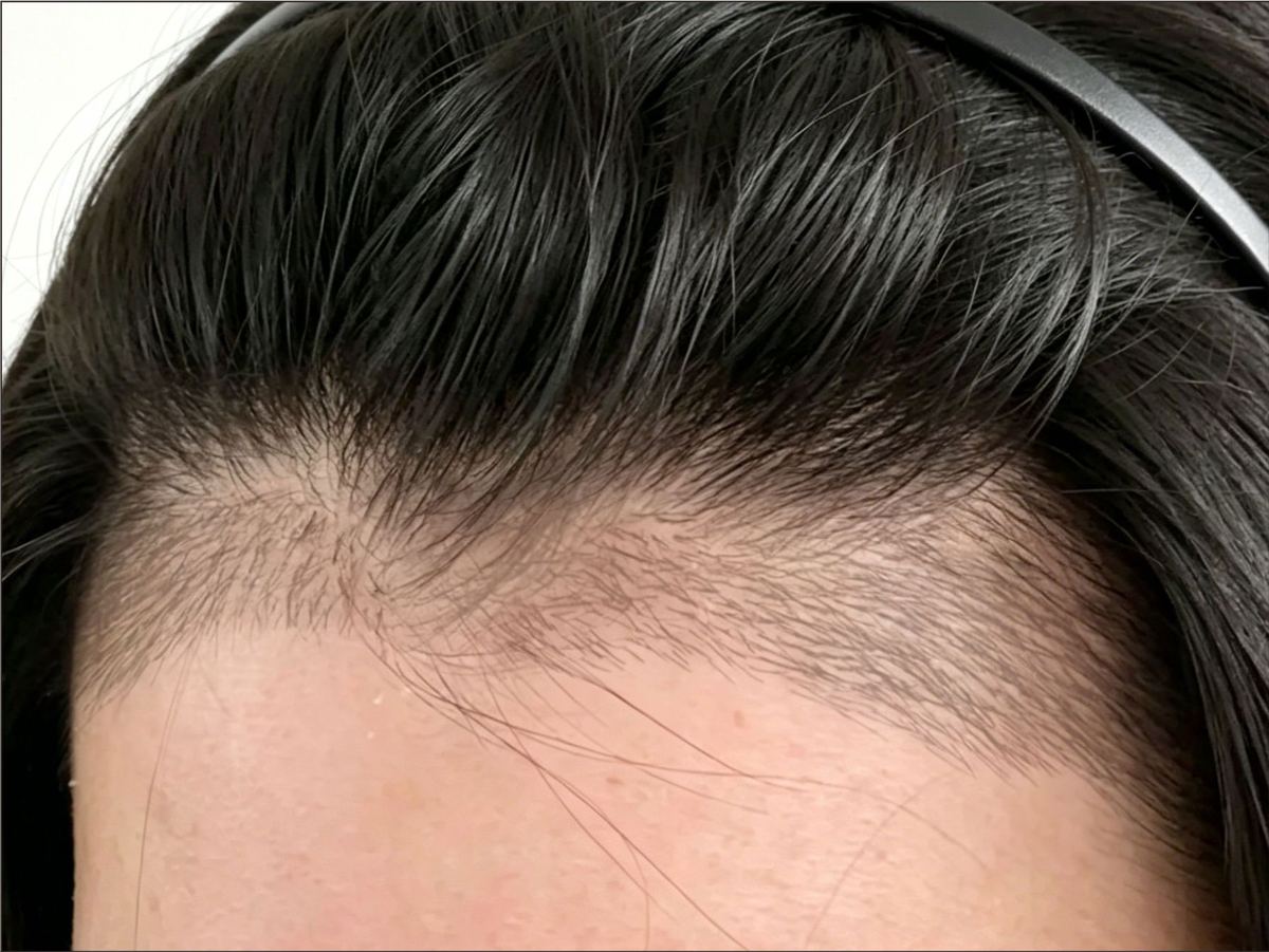 发际线种植项目示意